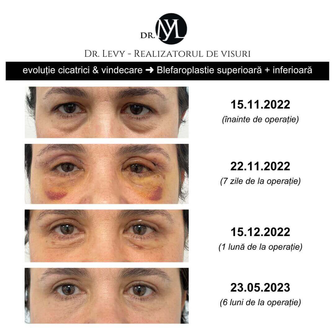 inainte-si-dupa-blefaroplastie-6