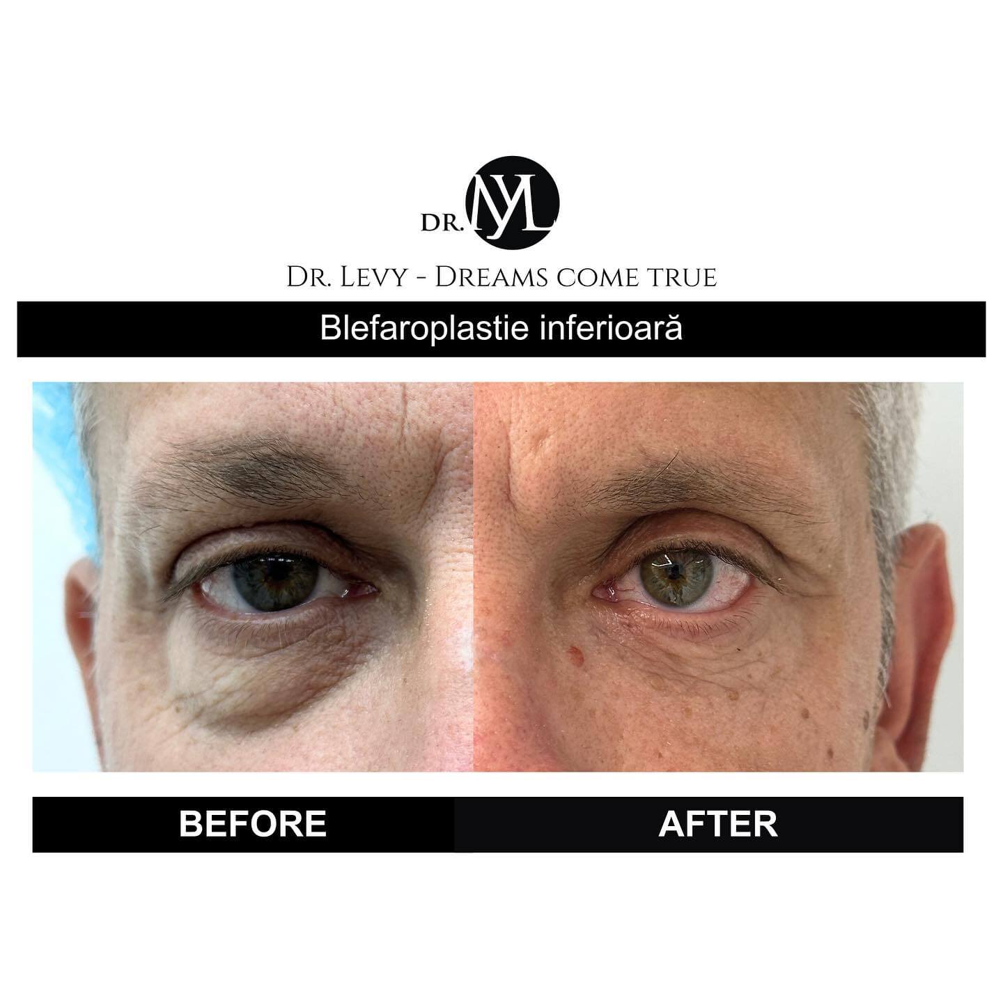 rezultat-operatie-blefaroplastie-2