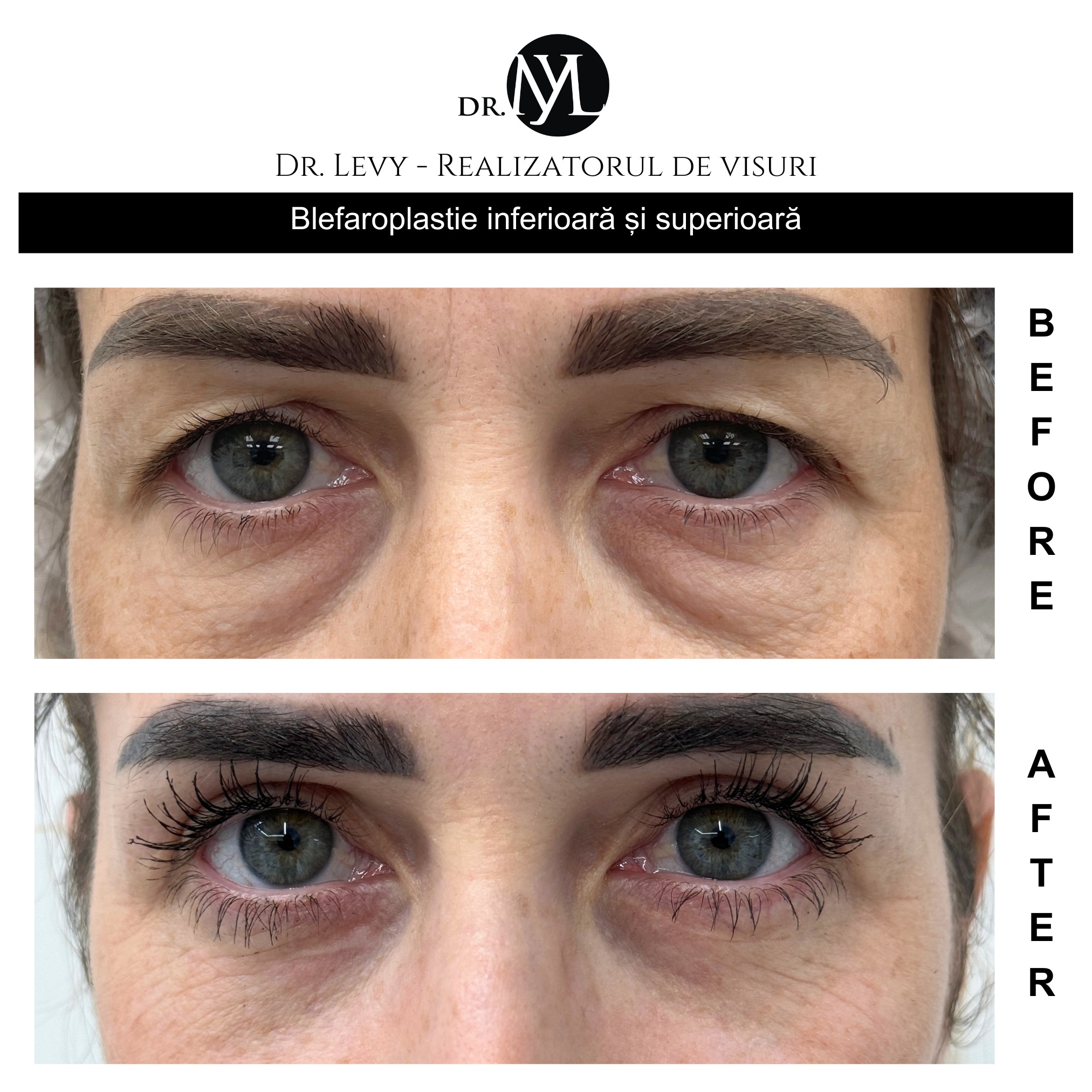 poze blefaroplastie superioara si inferioara